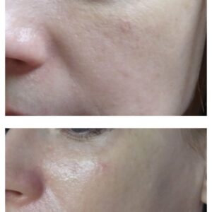 Carboxy Facial