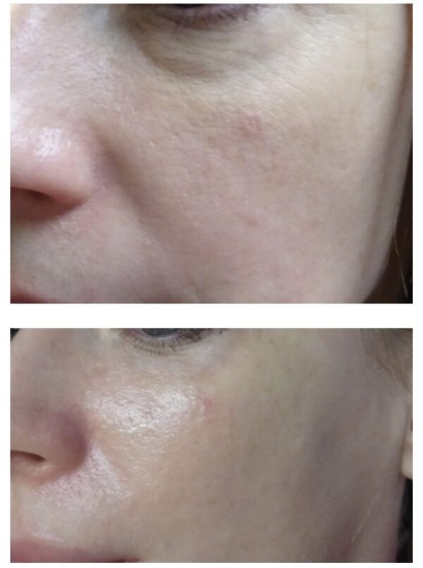 Carboxy Facial