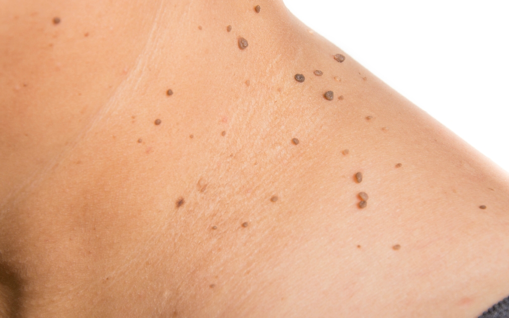 Födelsemärken-1 Microneedling